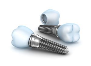 The Benefits of a Dental Implant and Crown 2 Dental Implant and Crown