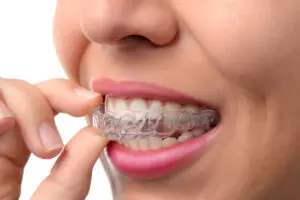 Invisalign - The Clear Alternative to Braces 5 pros-and-cons