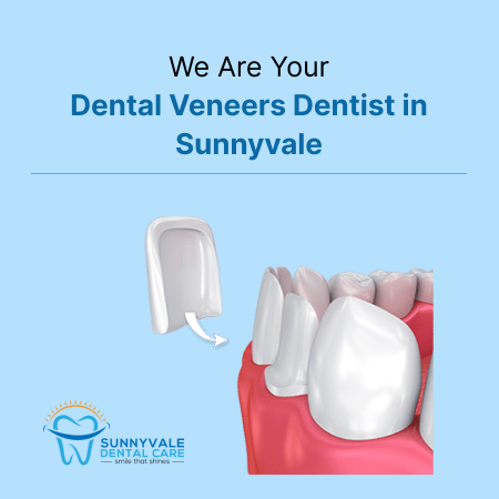 Dental Veneers Dentist in Sunnyvale
