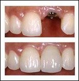 Benefits of Implants 1 Dental Implant Dentistry 1