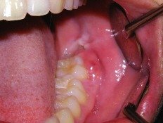 Problems Associated with Wisdom Teeth 1 Third Molars Problems 1