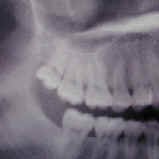 Problems Associated with Wisdom Teeth 9 Third-Molars-Problems-10a