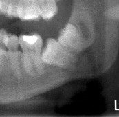 Problems Associated with Wisdom Teeth 10 Third-Molars-Problems-11a