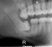Problems Associated with Wisdom Teeth 11 Third-Molars-Problems-12a