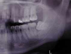 Problems Associated with Wisdom Teeth 2 Third-Molars-Problems-2a