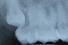 Problems Associated with Wisdom Teeth 3 Third-Molars-Problems-3a