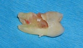 Problems Associated with Wisdom Teeth 4 Third-Molars-Problems-4a