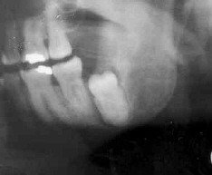 Problems Associated with Wisdom Teeth 5 Third-Molars-Problems-6a