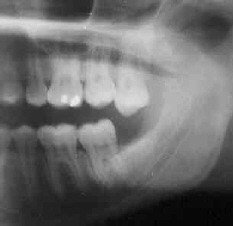 Problems Associated with Wisdom Teeth 6 Third-Molars-Problems-7a