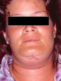 Problems Associated with Wisdom Teeth 7 Third-Molars-Problems-8a