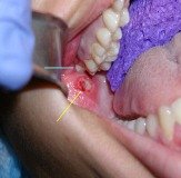 Problems Associated with Wisdom Teeth 8 Third-Molars-Problems-9a
