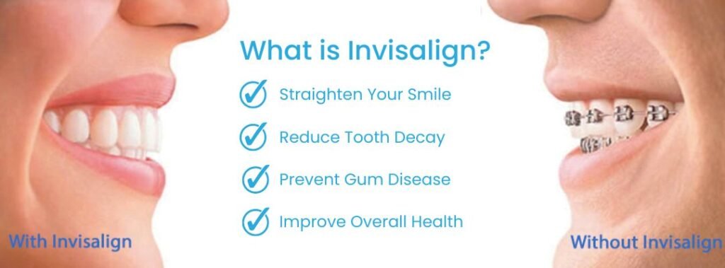 Invisalign Guide - Everything You Need to Know 2 What is Invisalign