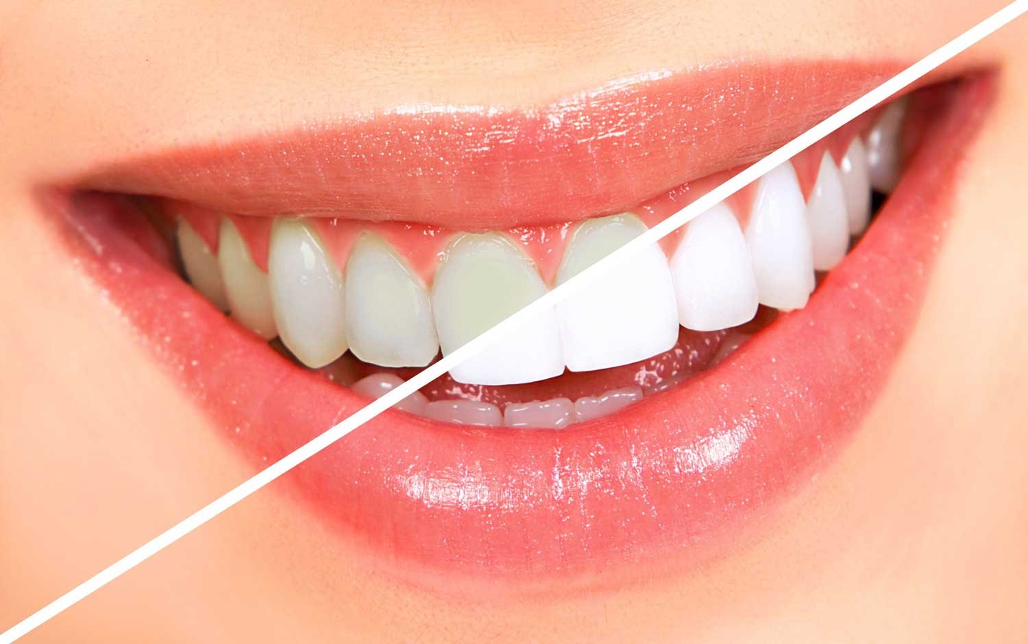 The Advantages and Disadvantages of Teeth Whitening 1 Invisalign guide - everything you need to know