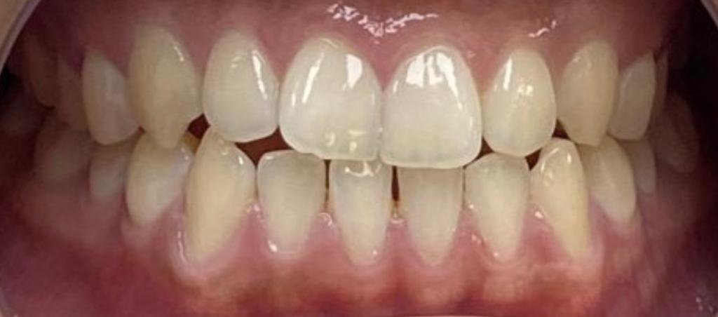 National Align Your Teeth Day at Sunnyvale Dental Care 2 teeth_ 3