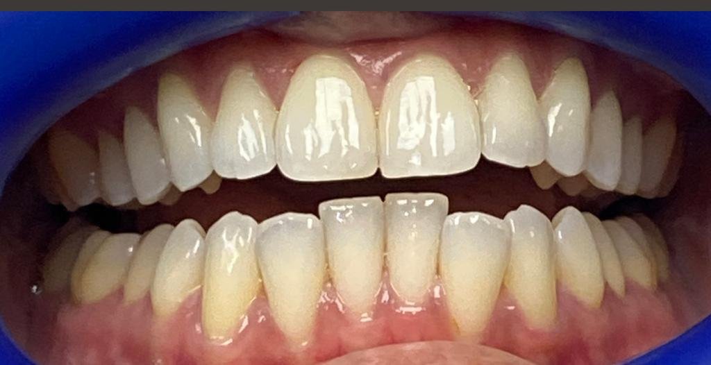 National Align Your Teeth Day at Sunnyvale Dental Care 4 teeth 2