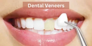 What is Teeth Gap: How to Fix Your Diastema? 3 Dental Veneers as Teeth Gap (Diastema) Treatments