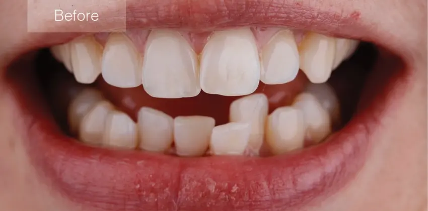 Home Page 28 Invisalign before after sunnyvale