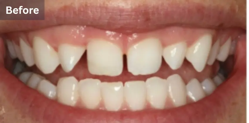 Home Page 26 Invisalign before after sunnyvale