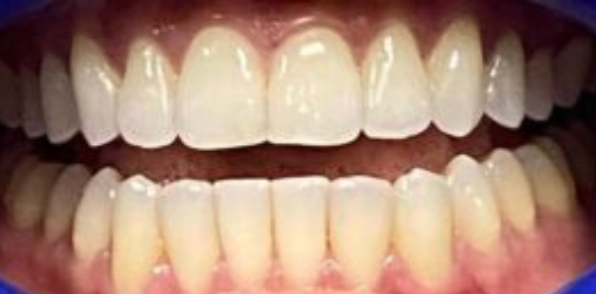 Invisalign Dentist Sunnyvale 21 Invisalign-before-after-sunnyvale