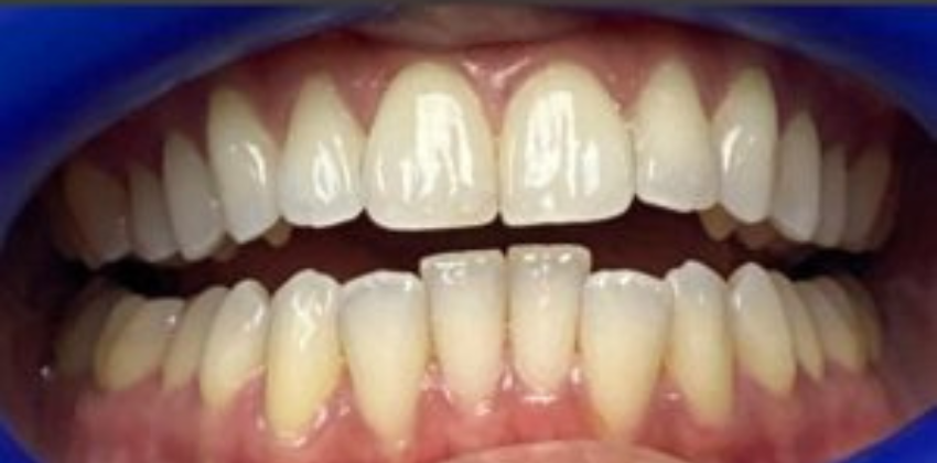 Invisalign Dentist Sunnyvale 17 Invisalign-before-after-sunnyvale