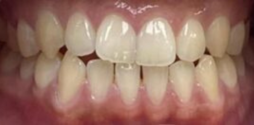 Invisalign Dentist Sunnyvale 19 Invisalign-before-after-sunnyvale