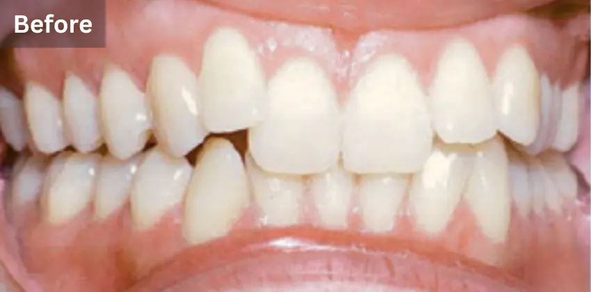 Home Page 30 Invisalign before after sunnyvale