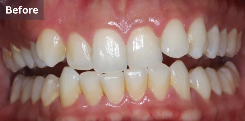Invisalign Dentist Sunnyvale 9 Invisalign before after sunnyvale