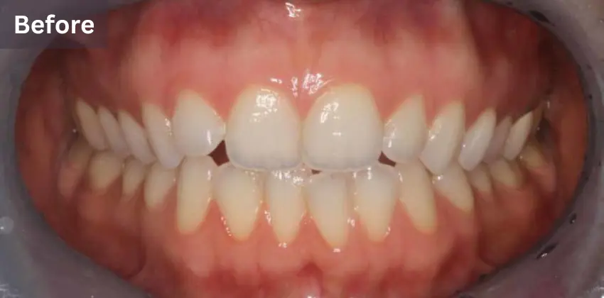 Invisalign Dentist Sunnyvale 11 Invisalign before after sunnyvale