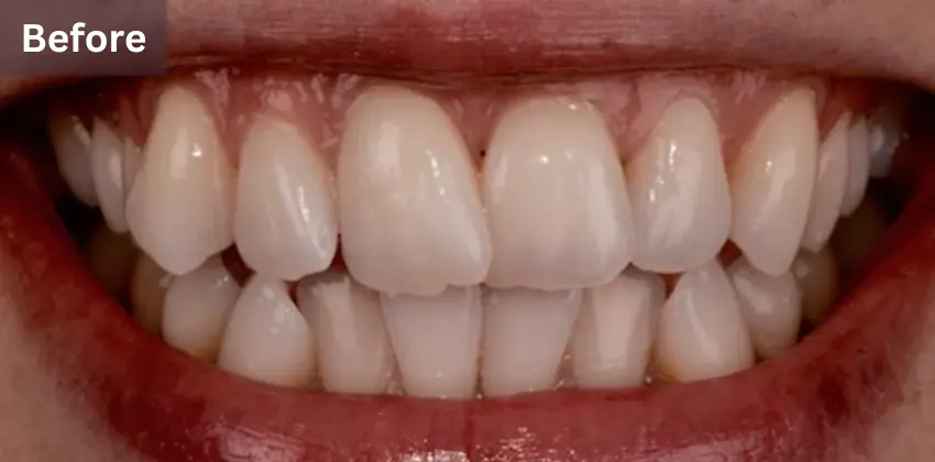 Invisalign Dentist Sunnyvale 13 Invisalign before after sunnyvale
