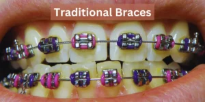 What is Teeth Gap: How to Fix Your Diastema? 1 Traditional Braces as Teeth Gap (Diastema) Treatment