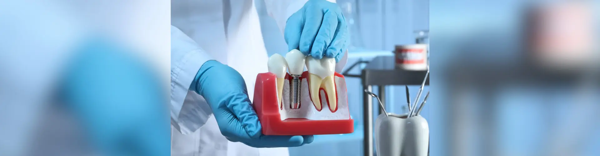 How Much Are Dental Implants and Tips to Reduce Implants Cost 1 Sunnyvale dental implant cost