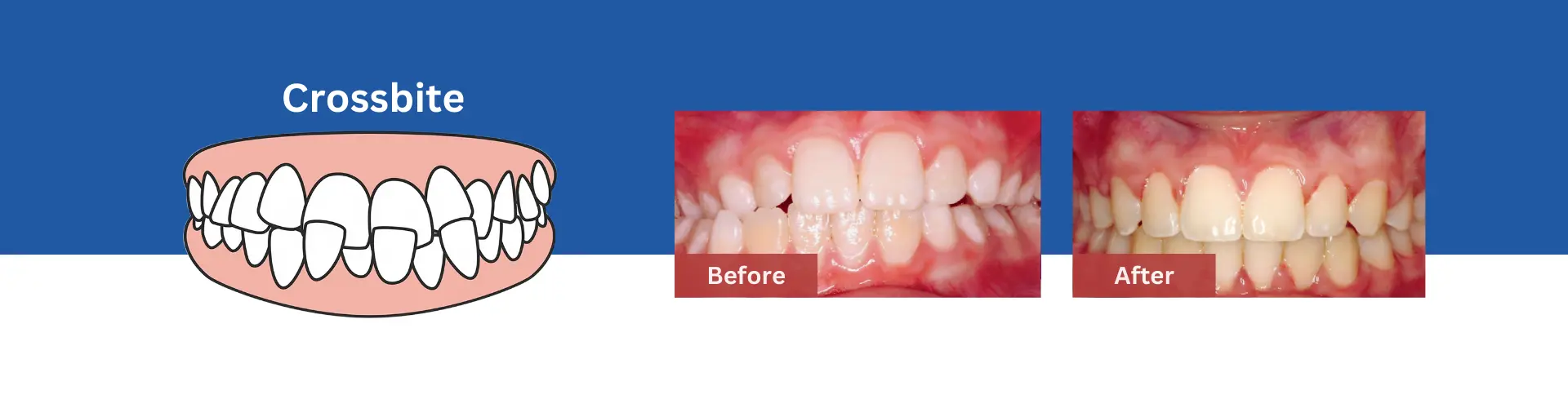 Crossbite Treatment in Sunnyvale 3 Crossbite-treatment-Sunnyvale