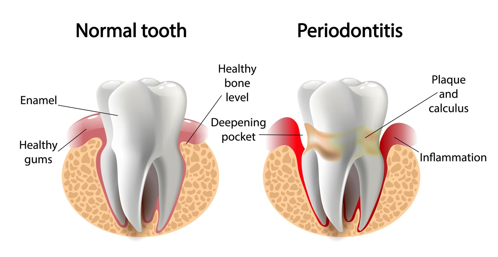 Sunnyvale Dental Care: Navigating Periodontal Disease and Decay 6 vector image tooth