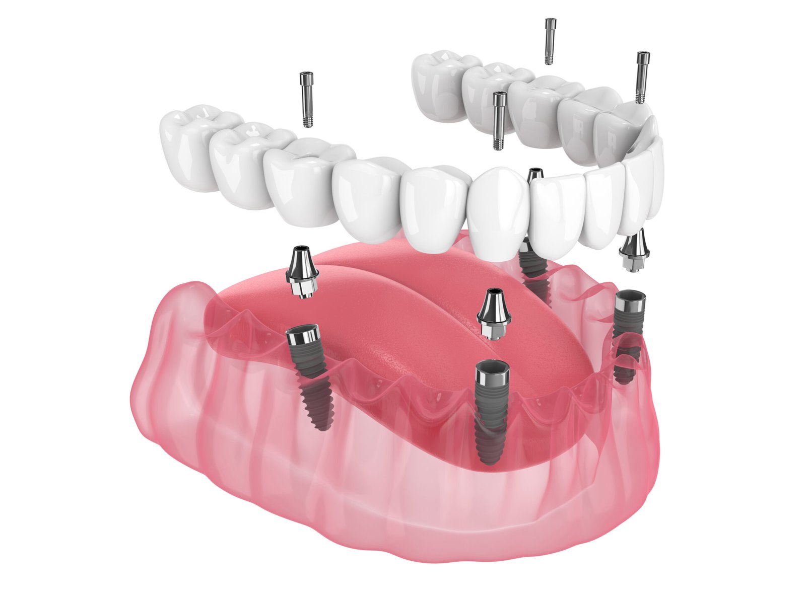 Will All-on-4 Dental Implants Affect My Daily Oral Care Routine in Sunnyvale, CA? 2 Will All-on-4 Dental Implants Affect My Daily Oral Care Routine in Sunnyvale, CA?